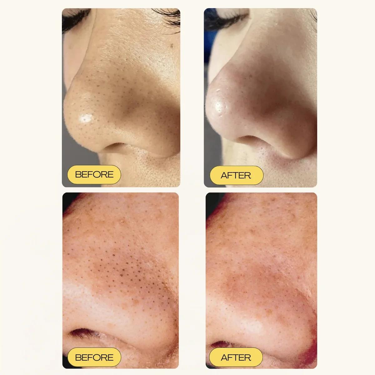 DEEP CLEANSING PATCH SYSTEM